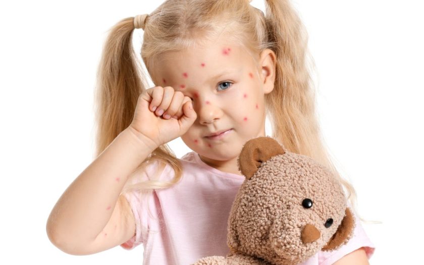 How to recognize chickenpox