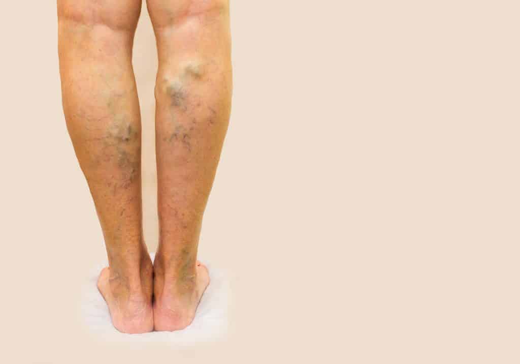 Varicose veins (varicose veins) - cause, symptoms and treatment