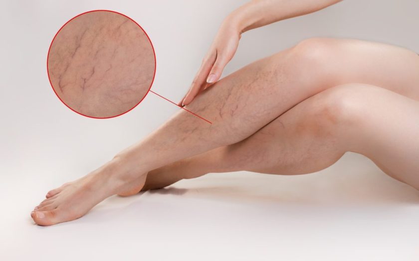 Veins on the legs natural healing