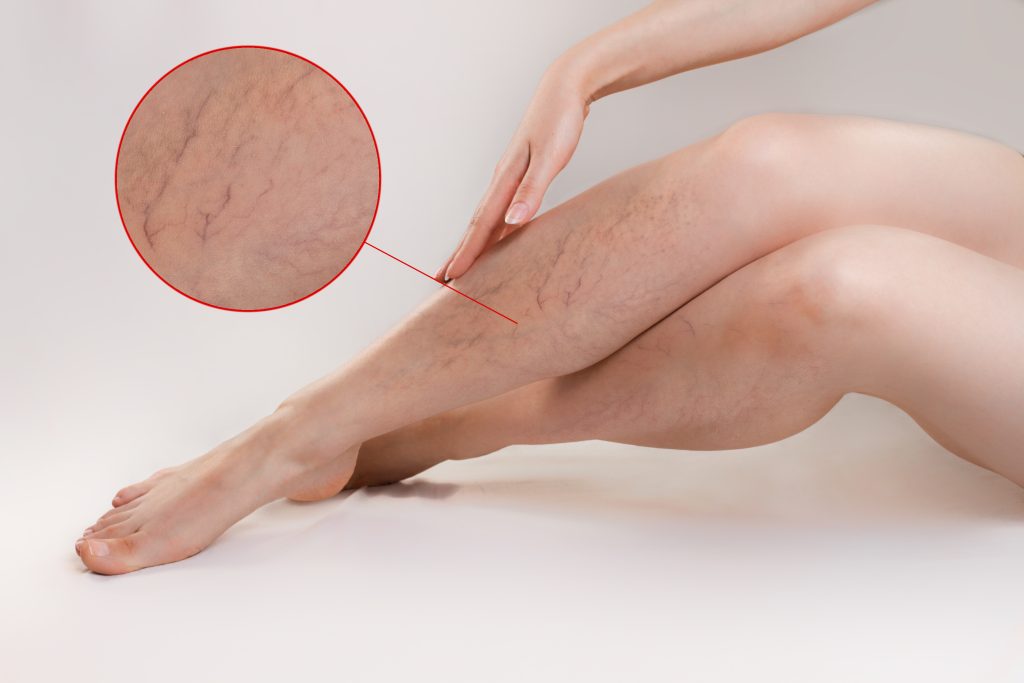 Veins on the legs natural healing