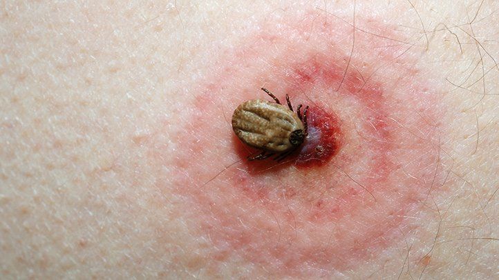 tick bite pictures on humans